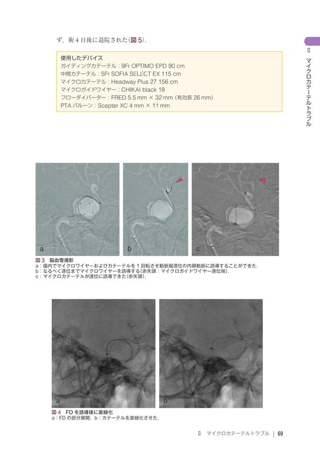 2553脳血管内治療トラブルシューティング 脳動脈瘤編 改訂第2版