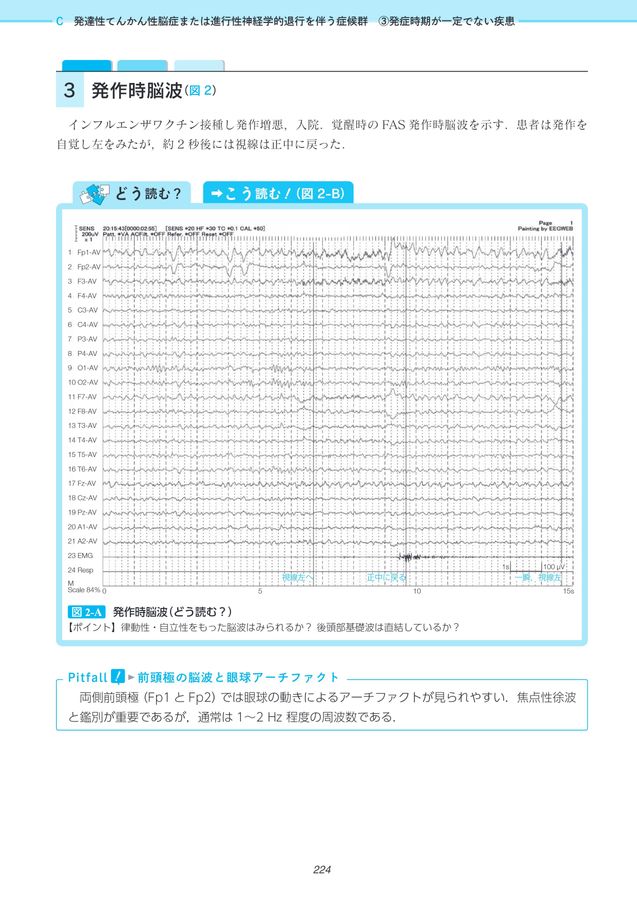 2648新版てんかんの発作間欠期・発作時脳波