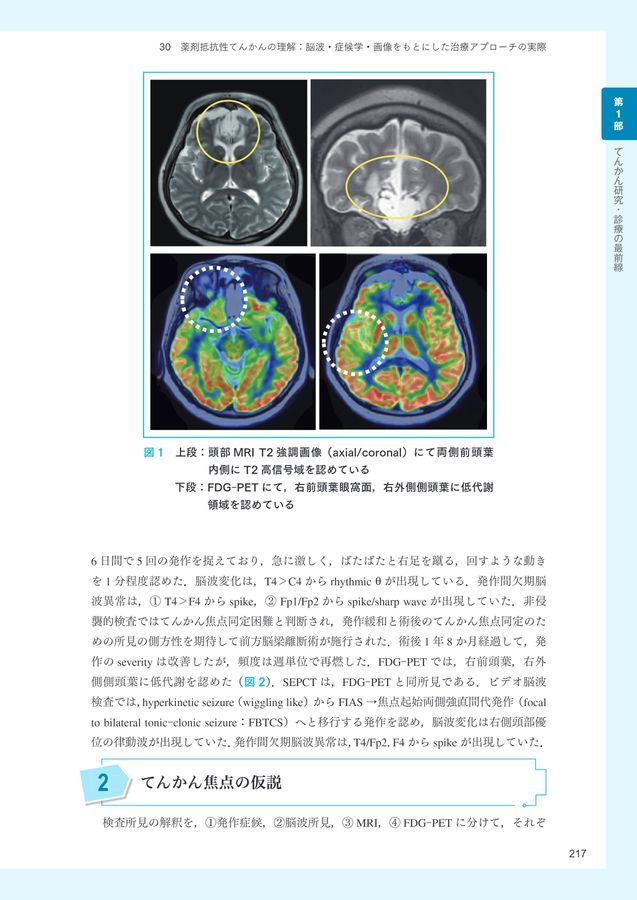 2688てんかん研究・診療の進歩